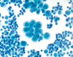 pleural mesothelioma is a malignant cancer that develops on the lining of the lungs called the pleura. Syed Z Ali Twitterissa Deviations From Usual Traditional Morphology Are Not Infrequent In Cytopathology I Always Rely On The Presence Of Discrete Macronucleoli When Diagnosing Mesothelioma In Effusions This Case Of Pleural Mesothelioma