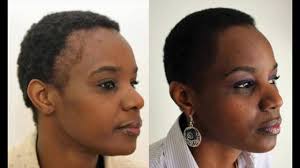 Come see actual hair transplant 'before' & 'after' photo examples from people here in the san francisco bay area and san jose area. Fue Hair Transplant Black Women African 1382 Grafts Full Shaven Fue Hair Transplant Hair Transplant Women Hair Transplant Results