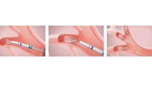 How A New Valve Therapy For Copd Helped One Patient Breathe Easier