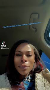 Wisdom Tooth Removal Anna Before and After