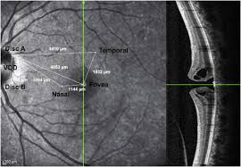 Chat with a business advisor. Nasal Or Temporal Internal Limiting Membrane Flap Assisted By Sub Perfluorocarbon Viscoelastic Injection For Macular Hole Repair American Journal Of Ophthalmology