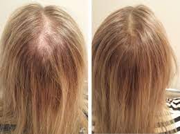 If you are prone to hereditary hair loss, menopause makes it worse. Causes Of Hair Loss In Women Female Hair Loss Top 8 Causes