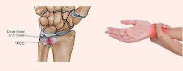 The tfc is an articular discus that lies on the pole of the distal ulna. Triangular Fibrocartilage Complex Injury Tfcc Motus Physical Therapy