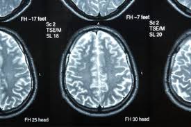 Pudarnya rasa kepekaan penderita tumor otak akan mengalami perubahan persepsi tentang sentuhan atau tekanan, kelemahan lengan atau kaki pada 1 sisi tubuh, atau kebingungan dengan sisi kiri dan. Tanda Tanda Sakit Otak Mencapai Matlamat Kesihatan Anda Dengan Alat Makanan Dan Kecergasan Praktikal Sumber Pakar Dan Komuniti Yang Terlibat