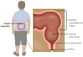 Image result for Encopresis