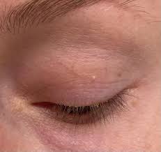 Image result for milium cyst on eyelid