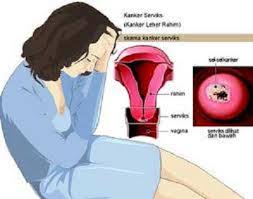 Wajar saja karena menurut data who (badan kesehatan dunia), penyakit kanker serviks ini menempati peringkat teratas penyebab. Informasi Kesehatan Gejala Kanker Serviks Pada Wanita Dinas Kesehatan Kabupaten Agam
