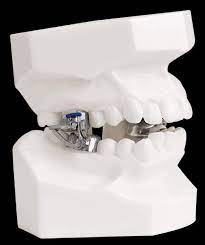 Once the orthodontist inserts the contraption into the patient's mouth, it remains there until the. Mandibular Anterior Repositioning Appliance Mara Dynaflex