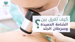 شاهد الفرق بين الشامة الحميدة وسرطان الجلد Youtube