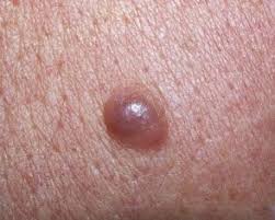 Whether you have acne, psoriasis, eczema, rosacea, or any other type of skin condition, you&#x27;ll receive prompt treatment and advanced care such as laser therapy, when appropriate. Purple Pimple Draws Blood When Popped Melanoma Scary Symptoms