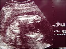 2nd And 3rd Trimester Ultrasound Scanning