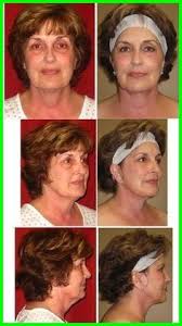 Your aging jowls may also be less prominent if you are. How To Get Rid Of Jowls On The Face How