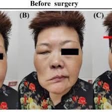 PDF) Modified hypoglossal-facial nerve anastomosis for peripheral-type  facial palsy caused by pontine infarction: A case report and literature  review