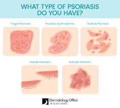 Image result for psoriasis