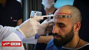 كلفة زراعة الشعر bbc news عربي hair transplantation radio hair