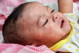 Image result for measles