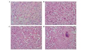 We did not find results for: Clinicopathological Characteristics Of Pulmonary Epithelioid Hemangioendothelioma A Report Of Four Cases And Review Of The Literature