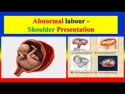 Image result for Shoulder Presentation