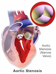 Learn vocabulary, terms and more with flashcards, games and other study tools. Heart Murmur Definition Causes Symptoms Treatment Study Com
