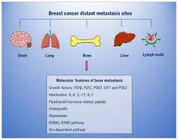 Has spread to lymph nodes under and above the collarbone and inside the breast and nodes, but not other parts of the body. Ijms Free Full Text Breast Cancer Derived Extracellular Vesicles In Bone Metastasis Induction And Their Clinical Implications As Biomarkers Html