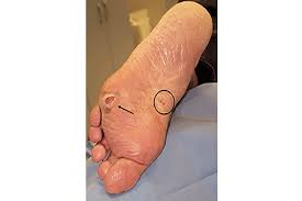 Image result for brown patches on the feet