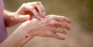 Image result for Atopic Patient