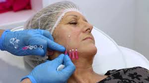 First Lift LFL PDO Threads, Dr Martyn King