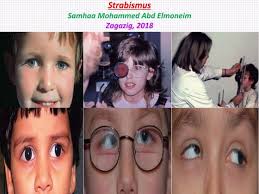 Monitoria de la relajacion neuromuscular