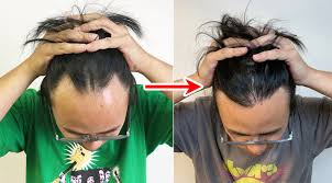 @glampire.gangthis is not an update video on how i care for my hair. Is It Okay To Bleach Hair That Has Been Surgically Transplanted Seiji Reports On His Hairline Soranews24 Japan News