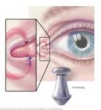 Image result for how does treatment with tetracycline help with dry eyes