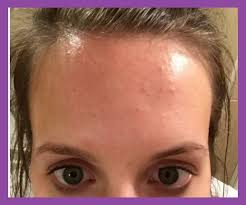 Pin On Forehead Acne