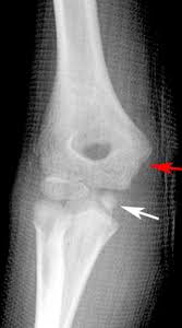 Kids with this injury report pain on the inside of their elbow and maybe some elbow laxity (increased bending of the elbow) because those important ligaments are now loose. Clinical Practice Guidelines Medial Epicondyle Fracture Of The Humerus Emergency Department