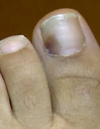 Vicks vapor rub, better known as vicks, is a mentholated ointment that is used for suppressing cough. What Does Toenail Fungus Look Like Toenail Fungus Pictures