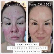 Skin sensitivities vary greatly from person to person, and the term sensitive skin is a general one that encompasses it can sometimes be difficult to know if you have sensitive skin or not, explains purvisha patel, m.d but pay attention to how your skin looks and feels throughout the day, as well. If You Have Sensitive Skin Redness Or Irritation Start With Our Soothe Regimen Soothe Will Sensitive Skin Care Sensitive Skin Care Routine Soothe Regimen