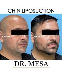Chin Liposuction By Dr. Mesa