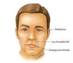 Other symptoms include drooping of the eyelid, a change in taste, and pain around the. What Is The Recovery Time For Bell S Palsy Quora