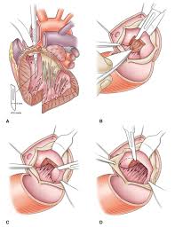 Image result for Left Ventricular Outflow Obstruction