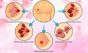 Pain in the breast skin changes in the breast area. Breast Cancer Types Symptoms Causes Treatment Of Breast Cancers