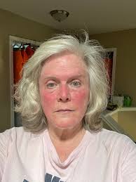 Heat Intolerance and Skincare Concerns While Planting Daylilies