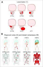 •consistent across all races (except nh others*) •more patients diagnosed at local stage •* nh others: Mitnm Categories And Pattern Of Bone Involvement For Reporting Prostate Download Scientific Diagram