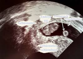Warum der hcg wert wichtig ist. Dein Baby Im Ultraschall Mamiwiki