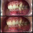Tooth coloured fillings product image