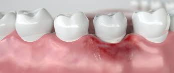 9 أسباب تؤدي إلى التهاب اللثة ويب طب