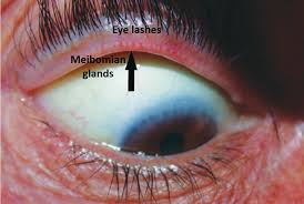 The red bumps are the body's reaction to this process. Swollen Eyelid Know The Causes Remedies And Alert Signs