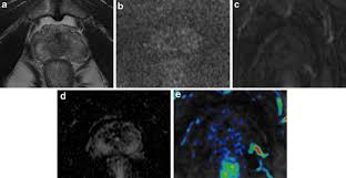 Continue shopping your session is about to timeout due to inactivity. Pitfalls In Interpreting Mp Mri Of The Prostate A Pictorial Review With Pathologic Correlation Insights Into Imaging Full Text