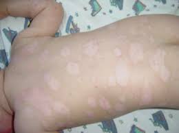 Palmar and plantar psoriasis usually cause the palms and soles to be partially or entirely covered in thickened, red skin. Poze Psoriazis Copii
