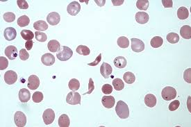 Sickle cell disease (scd) is a group of blood disorders typically inherited from a person's parents. Sickle Cell Anaemia Patients Upset With Kerala Govt Over Delay In Pension Jobs The News Minute
