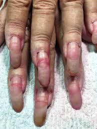 Ombre acrylic nails heart nails dream nails coffin nails matte stylish nails fire nails cute nails marble acrylic nails matte nails design. Nails Lifting From Nail Bed After Acrylic New Expression Nails