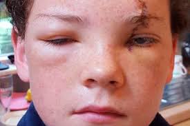 The blood was gushing out of my eye'