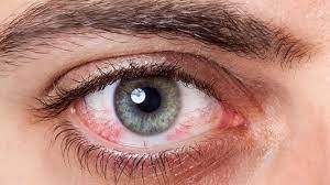 Allergie Neurodermitis Wenn Pollen Neurodermitis Ins Auge Treiben Rbb